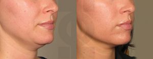 before_after_ultherapy_results_under-chin18