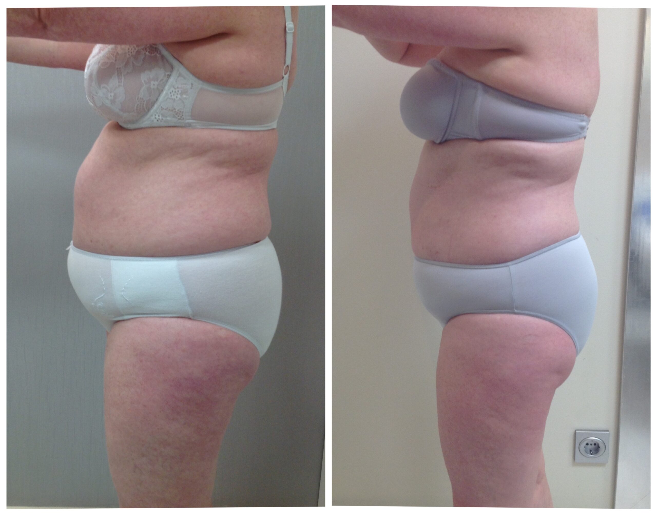 Reducir cintura, remodelar abdomen - Marquessa Tratamientos Estéticos