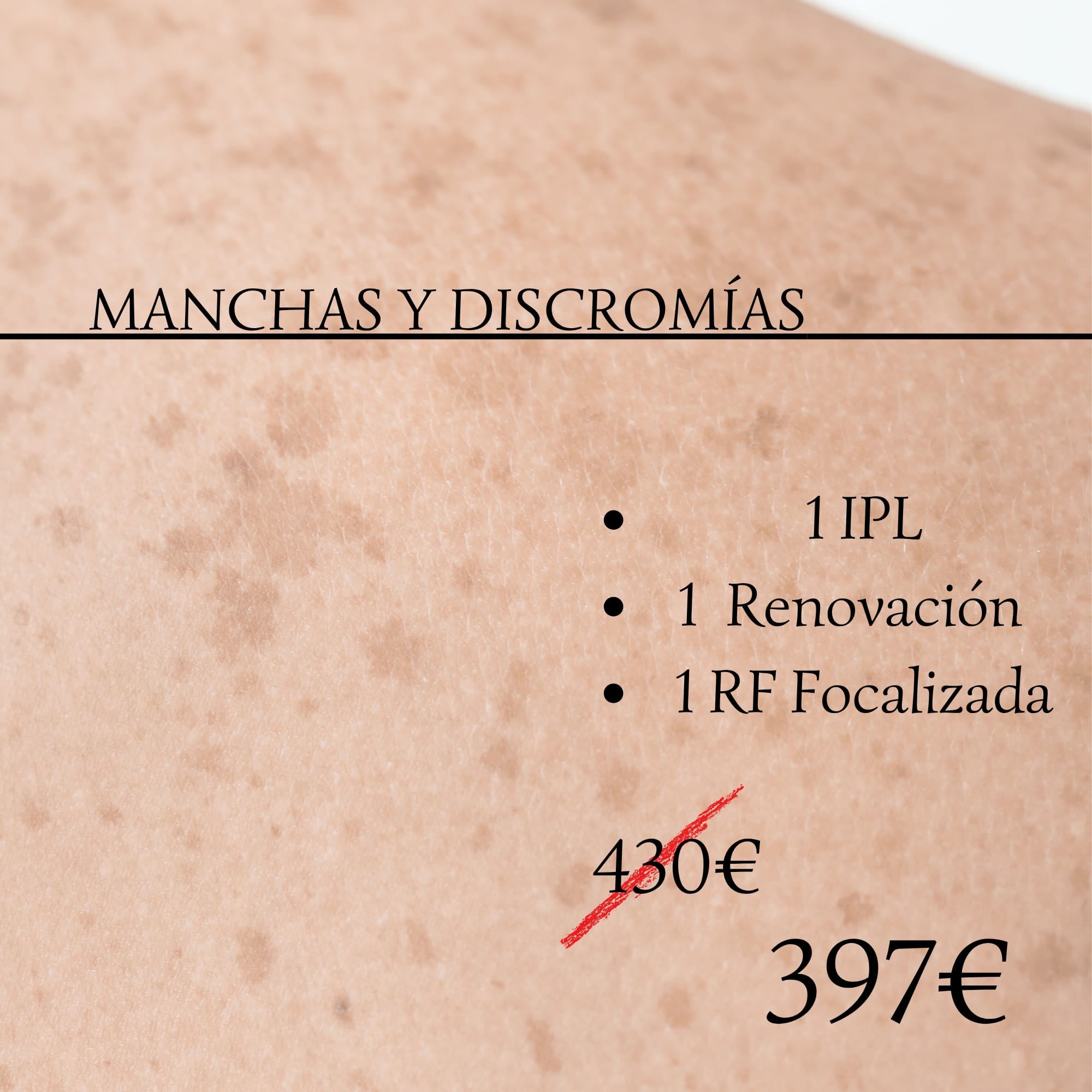 Manchas y Discromías facial (Oviedo y Gijón)